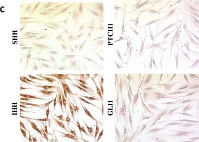 Immunocytochemistry of fibroblasts and oral squamous carcinoma cells showing specific immunolableing of Patched 1/PTCH Antibody in upper right.  Magnification: 400x. Image from the following publication (//pubmed.ncbi.nlm.nih.gov/32899449/) licensed under a CC-BY license.