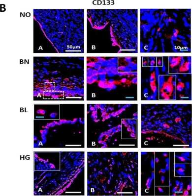  Immunostaining of normal ovarian and tumor tissue sections showing specific labeling of CD133.  Staining of CD133 in OSE layer (A, B) as well as cortex (C) reveals specific CD133+ cells with relatively higher cell numbers in BL and HG. Area within dotted lines in BN OSE (A) are magnified in (B) while elliptical/spindle shaped CD133+ cells in cortex from various fields were represented in the composite image in (C) of BN and HG. Large CD133+ cells in cortex were also observed.  Image from the following publ