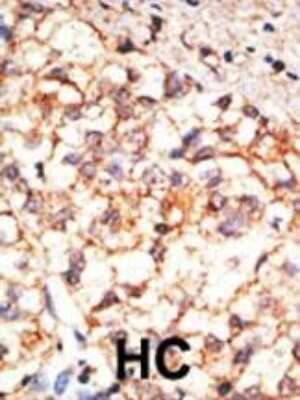 Immunohistochemistry of human hepatocarcinoma (HC) tissue showing specific staining of CD133.