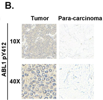 Representative ABL1p-Y412 (cat. AP1271) immunohistochemistry of tumors or para-carcinom in human breat cancer tissue are shown. Image from publication CC-BY-4.0. PMID: 39060421