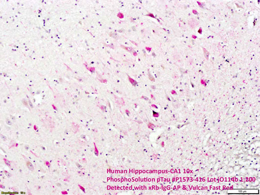 Immunostaining of FFPE human hippocampus-CA1 neurons labeling tau phosphorylated at Ser 416 (cat. p1573-416, 1:200, red). The bright red stain labels the phosphorylated neurons while the thin, thread like stain labels the dystrophic neurites identifying the characteristic lesions of Alzheimer diseased tissue. Photo courtesy of Benecia Hong-Goka, Indiana Univ. SOM)