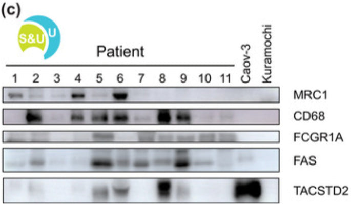 Western blotting for selected HGSC‐specific EV‐associated proteins on U fractions of 11 patients and Caov‐3 and Kuramochi HGSC cell lines. Caov‐3 and Kuramochi cells are used as negative controls for macrophage markers MRC1, CD68, and FCGR1A. For TACSTD2 (cat. TM0051, 1:500), Caov‐3 serves as a positive control, while Kuramochi serves as a negative control. Image from publication CC-BY-4.0. PMID: 38490958